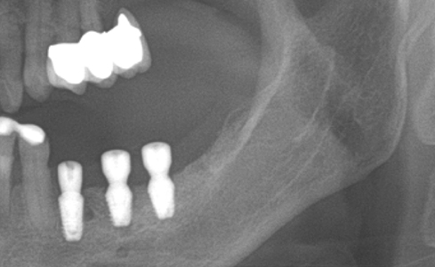 Partial edentulous clinical cases 22