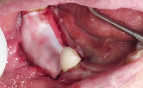 Partial edentulous clinical cases 3