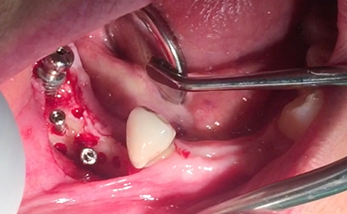 Partial edentulous clinical cases 4