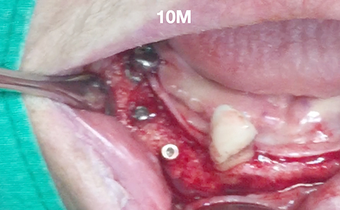 Partial edentulous clinical cases 5