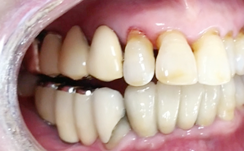 Partial edentulous clinical cases 6