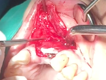 Partial edentulous clinical cases 7