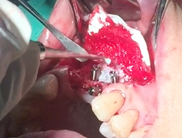 Partial edentulous clinical cases 8