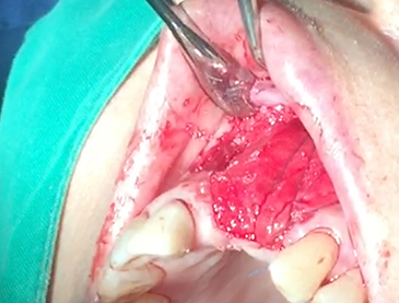 Partial edentulous clinical cases 9