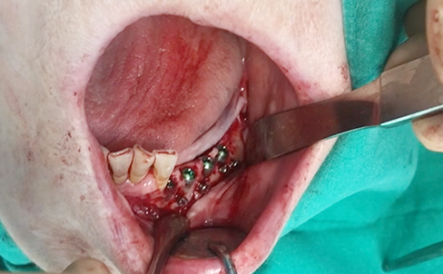 Simultaneous bone graft and implant placement 1