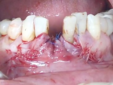 Simultaneous bone graft and implant placement 10