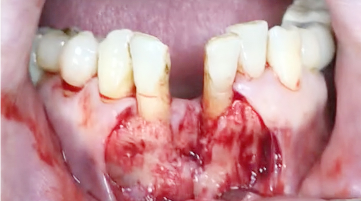 Simultaneous bone graft and implant placement 11