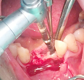 Simultaneous bone graft and implant placement 13