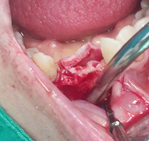 Simultaneous bone graft and implant placement 14