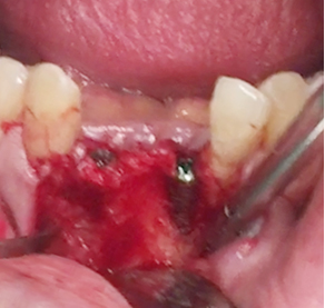 Simultaneous bone graft and implant placement 15