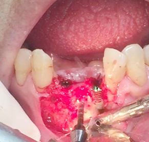 Simultaneous bone graft and implant placement 16