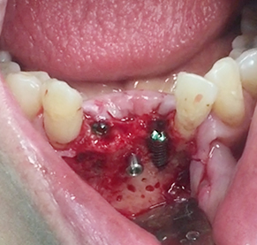 Simultaneous bone graft and implant placement 17