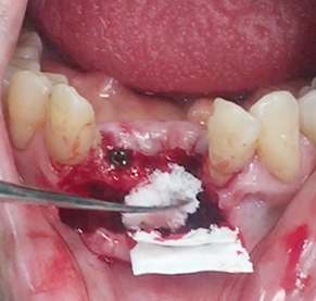 Simultaneous bone graft and implant placement 18