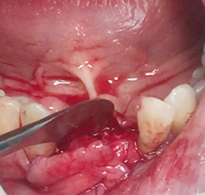 Simultaneous bone graft and implant placement 19