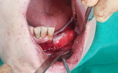 Simultaneous bone graft and implant placement 2