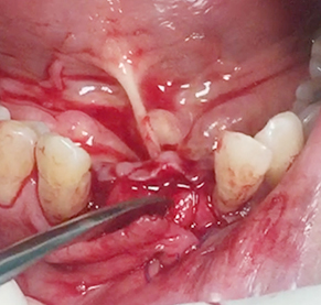 Simultaneous bone graft and implant placement 20