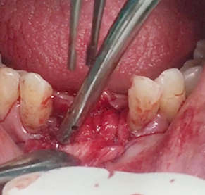 Simultaneous bone graft and implant placement 21