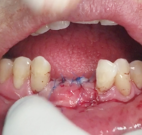 Simultaneous bone graft and implant placement 22