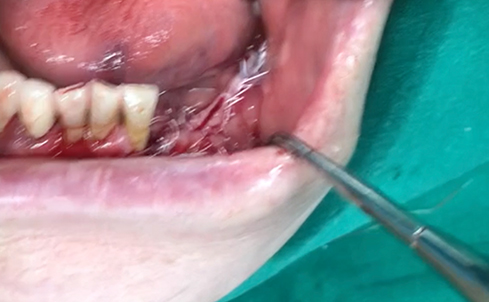 Simultaneous bone graft and implant placement 4