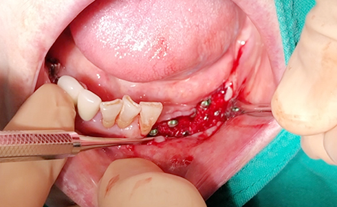 Simultaneous bone graft and implant placement 5