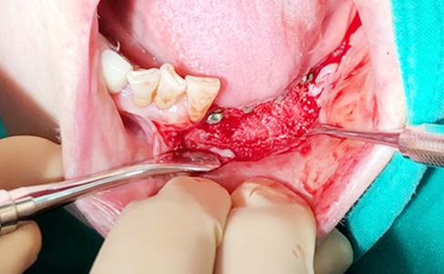 Simultaneous bone graft and implant placement 6