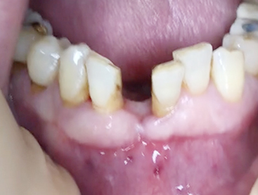 Simultaneous bone graft and implant placement 7