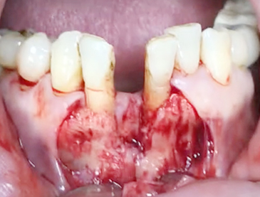 Simultaneous bone graft and implant placement 8