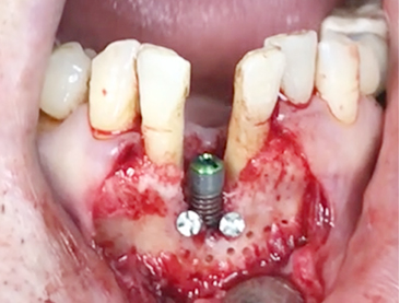 Simultaneous bone graft and implant placement 9