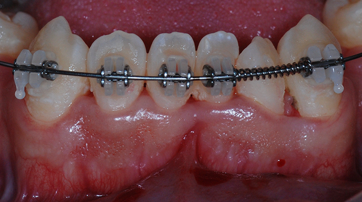 Gingival Phenotype Modification 1