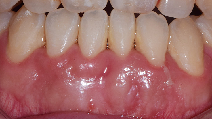 Gingival Phenotype Modification 2