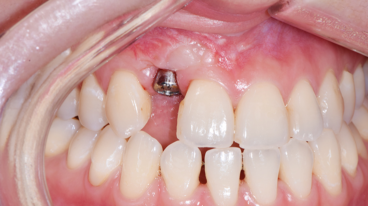 Coverage of exposed implant surface 2