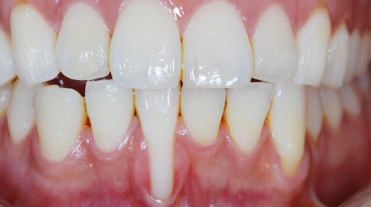 Coverage of denuded root surface 1