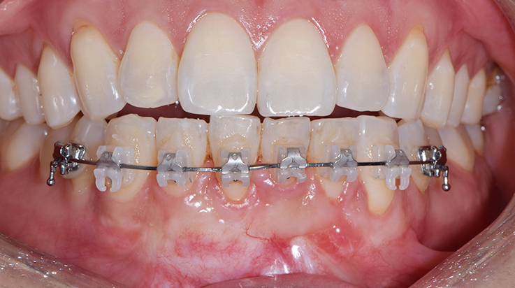 Coverage of denuded root surface 2