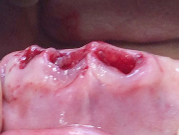 Alveoloplasty (Posterior teeth) 1