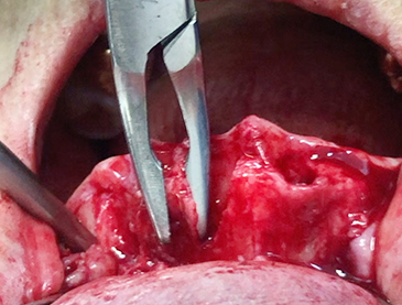 Alveoloplasty (Posterior teeth) 2