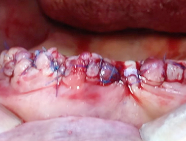 Alveoloplasty (Posterior teeth) 4