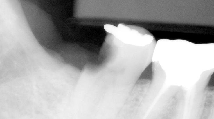 Crown lengthening (Posterior teeth) 1