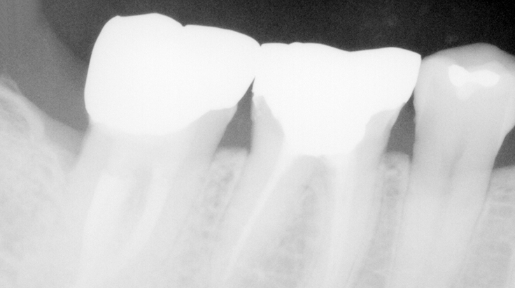 Crown lengthening (Posterior teeth) 2