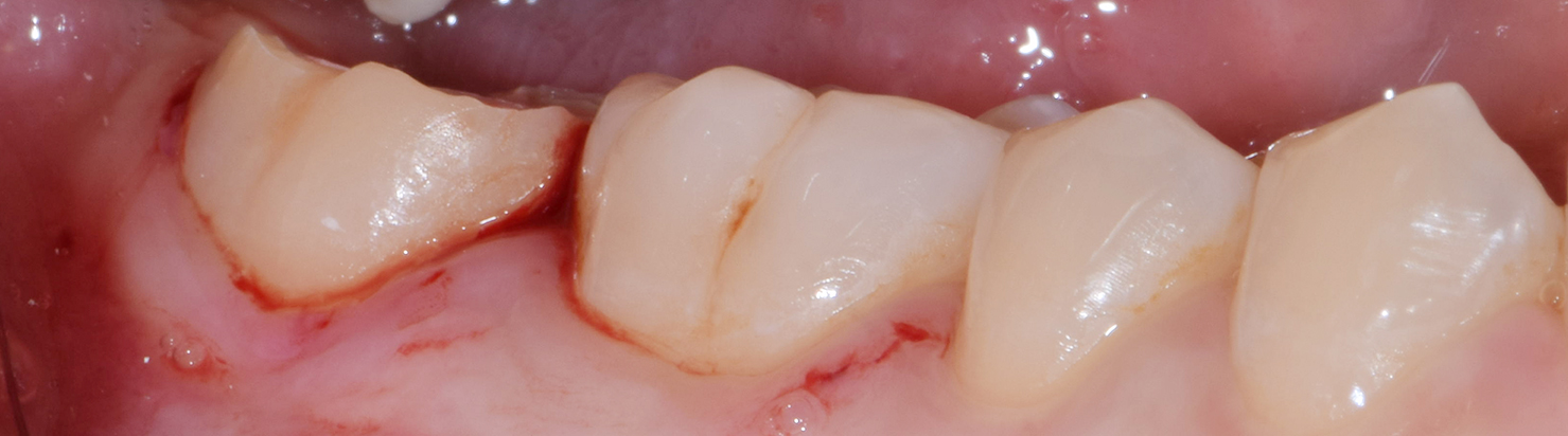 Crown lengthening (Posterior teeth) 3