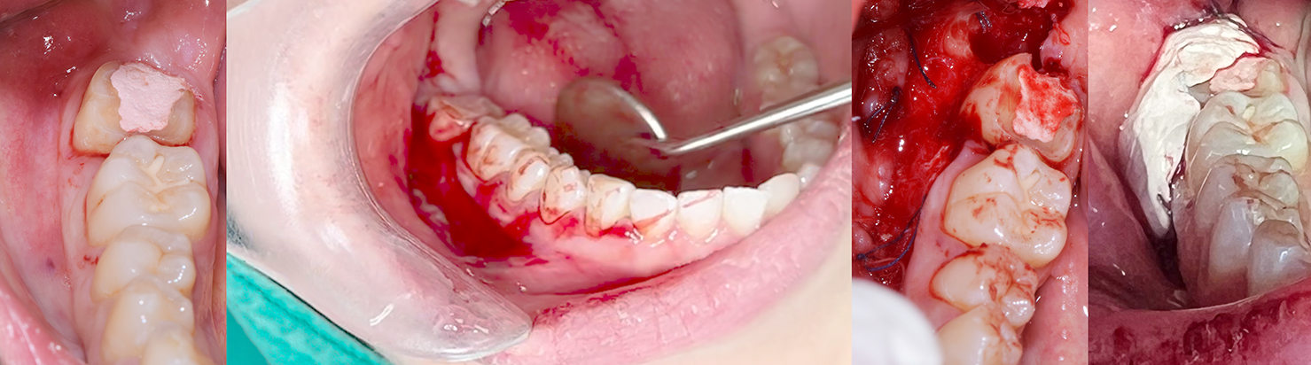 Crown lengthening (Posterior teeth) 4