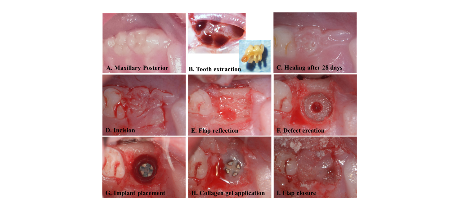 1) Tooth extration & Implant model