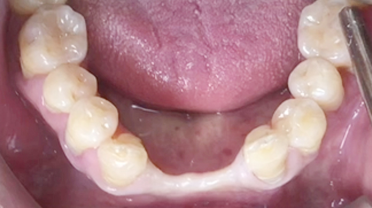 A surgical procedure using resorbable membrane 1