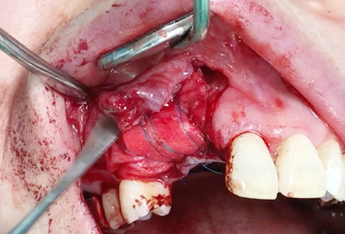 A surgical procedure using non resorbable membrane 5