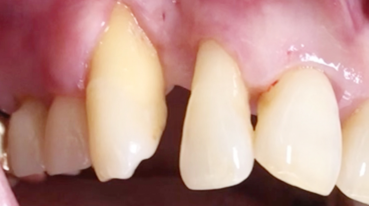 A surgical procedure using non resorbable membrane 6