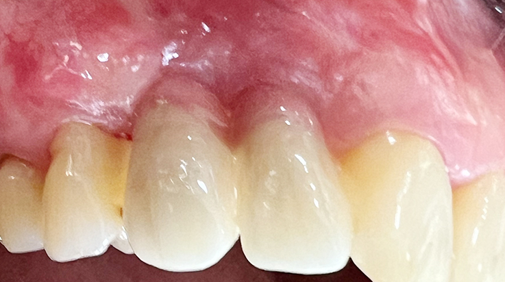 A surgical procedure using non resorbable membrane 7