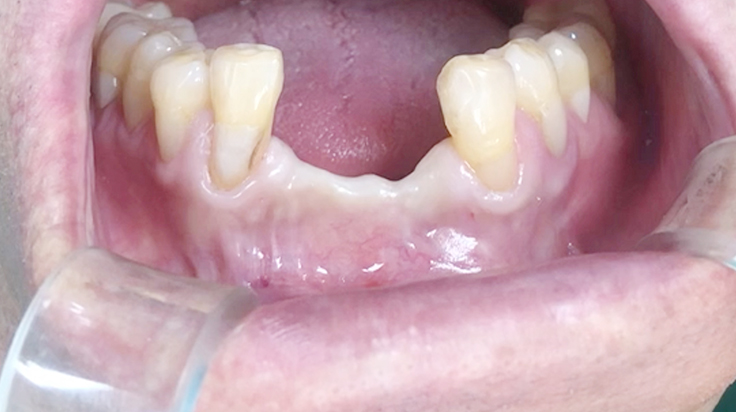 A surgical procedure using resorbable membrane 2