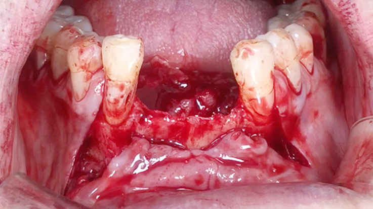 A surgical procedure using resorbable membrane 3