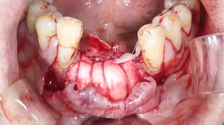 A surgical procedure using resorbable membrane 3