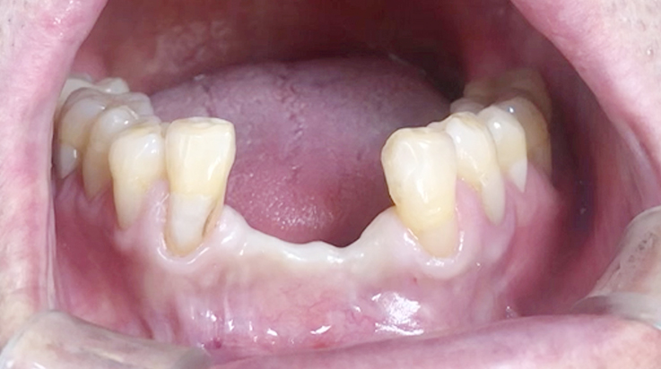 A surgical procedure using resorbable membrane 5