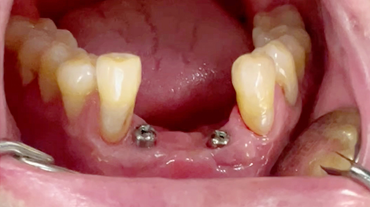 A surgical procedure using resorbable membrane 6